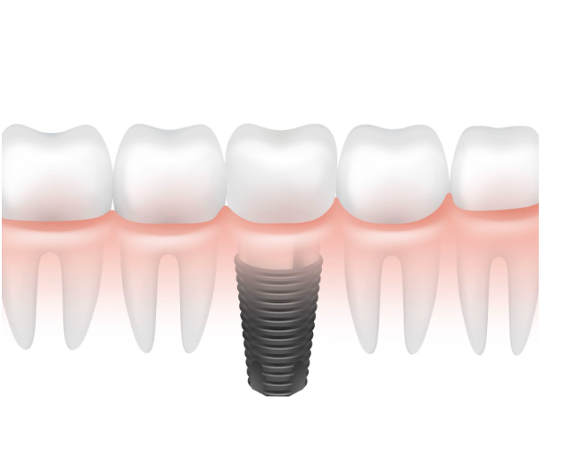 Best Places to Get Dental Implants in Indiana: Affordable Implants Dentistry