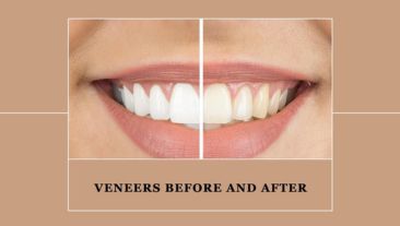 Veneers Before and After: Unveiling the Smile Transformation Journey