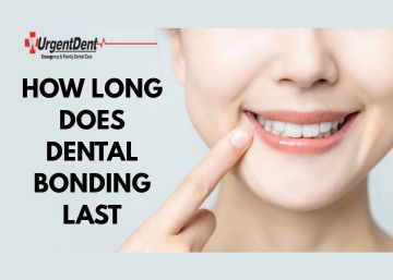 How Long Does Dental Bonding Last?