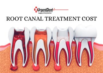 Root Canal Treatment Cost: Factors, Breakdown, and Saving Tips